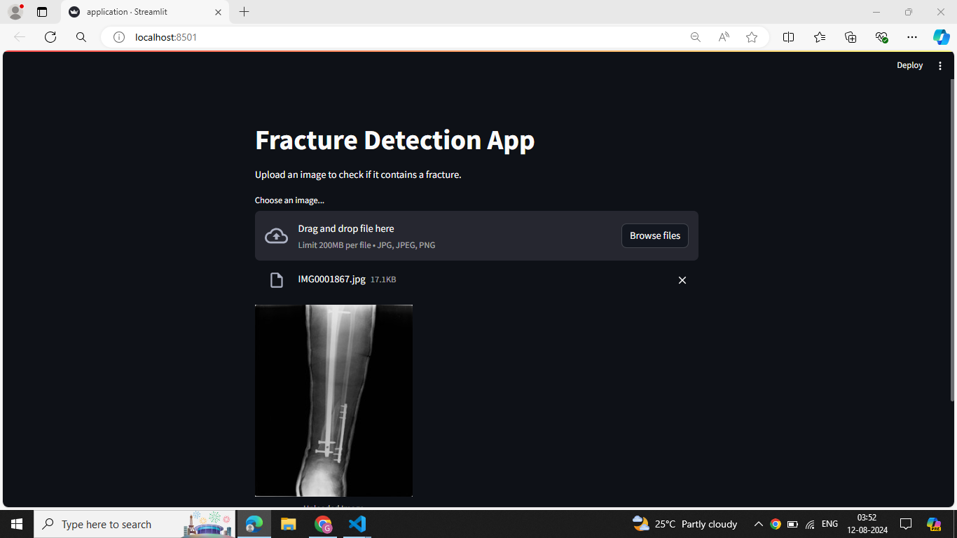 Bone Fracture Detection Using CNN